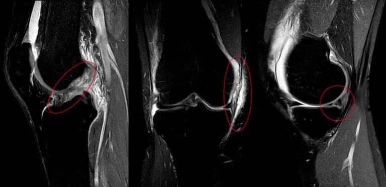 A ressonÃ¢ncia magnÃ©tica Ã© o exame mais importante para avaliar a lesÃ£o do LCA pois fornece dados nÃ£o sÃ³ do grau de comprometimento do ligamento como tambÃ©m de lesÃµes associadas de outras estruturas a exemplo dos meniscos e da cartilagem, muito frequentes na lesÃ£o do LCA.