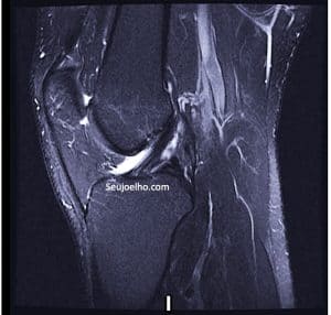 Ressonância magnética mostrando ligamento cruzado anterior normal do joelho Ressonancia magnetica mostrando ligamento cruzado anterior normal do joelho